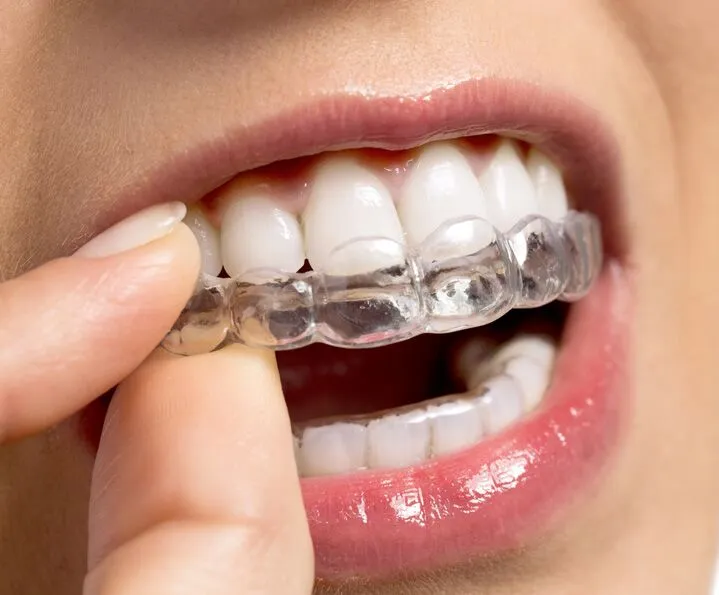 Why Patients Choose Invisalign Before Braces at Dentist Wimbledon
